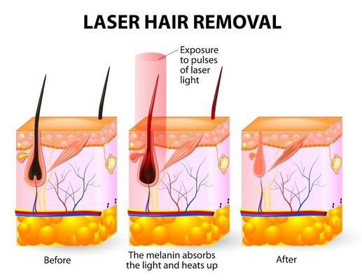 Máquina da remoção do cabelo do laser do diodo do salão de beleza 20HZ 808 dos termas