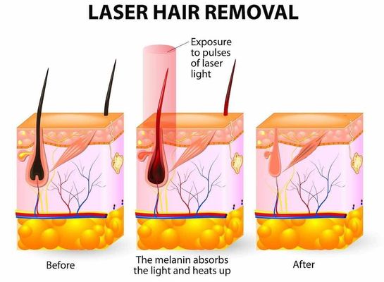 OPTAR o IPL/OPTAR a remoção rápida portátil do cabelo do IPL da máquina multifuncional