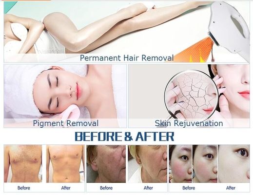 OPTAR o IPL/OPTAR a remoção rápida portátil do cabelo do IPL da máquina multifuncional
